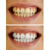 Teeth Whitening Gel 44% Syringes Carbamide Peroxide 20 Tooth Bleaching Gel 3ml Dispensers