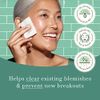Rael Toner, Miracle Clear Clarifying Toner - Facial Toner for Face, Oily and Acne Prone Skin, with Succinic Acid, Hydrating Vitamin B5, Vegan, Cruelty Free (5.1 oz)