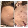 Demodexcillin Skin Solution 4 Fl.Oz Recommended For Acne, Rosacea, Blepharitis