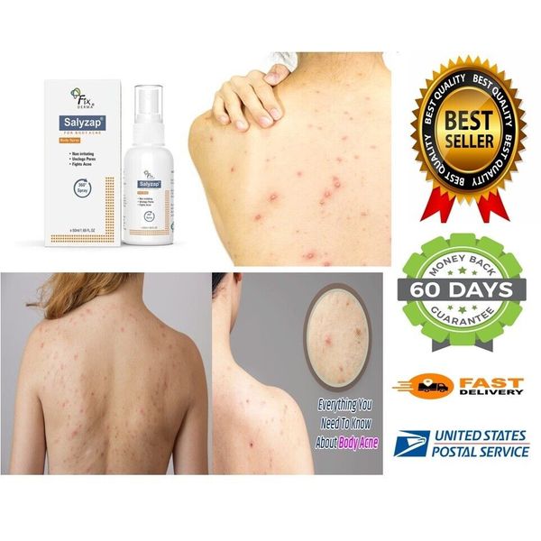 2% Salicylic Acid Salyzap Body Acne Spray (50ml) for Acne on Body