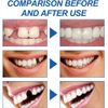 Lomeya Temporary Tooth Filling Kit - Replace Missing Teeth, False Teeth Filler - Easy, Effective Solution