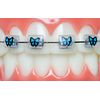 Braces Wax Alternative Bracket Cover Bumper Orthodontic Braces Accessories Snapcaps Butterfly 10 Ct.