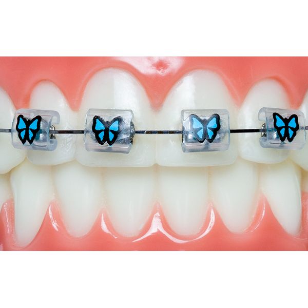 Braces Wax Alternative Bracket Cover Bumper Orthodontic Braces Accessories Snapcaps Butterfly 10 Ct.