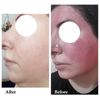 Demodexcillin Skin Solution 4 Fl.Oz Recommended For Acne, Rosacea, Blepharitis