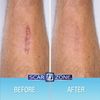 Scar Zone Advanced Scar Removal Cream - Scar Cream for Surgical Scars, Stretch Marks Removal, C Section & Fades Old & New Scars (0.75 oz, Pack of 3)