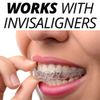 IXO Aligner Seater Chewies for Invisalign Trays - 10-Pack, Unscented, with Resealable Bag