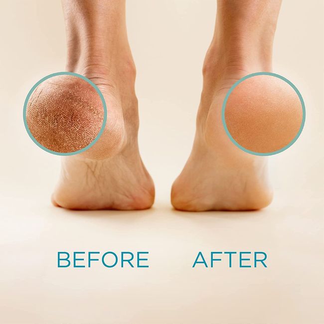 Callus Remover for Feet  Foot Scrubber for Dead Skin Remover
