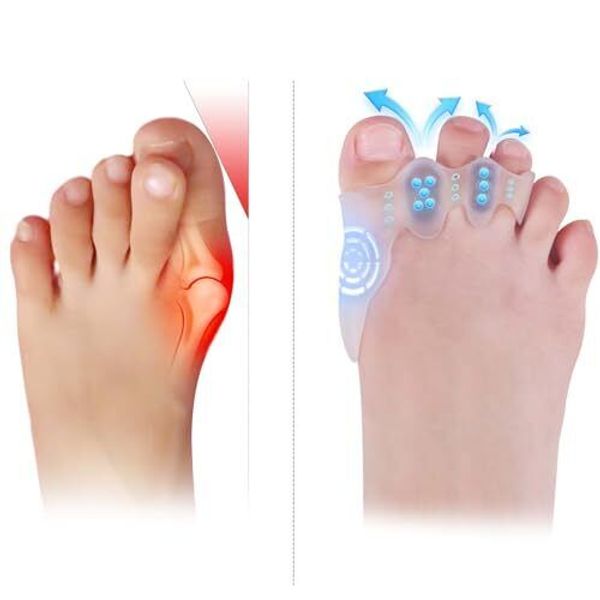 Toe Spacers & Bunion Corrector for Kids | Toe SeparatorsCorn Callus Removers|...