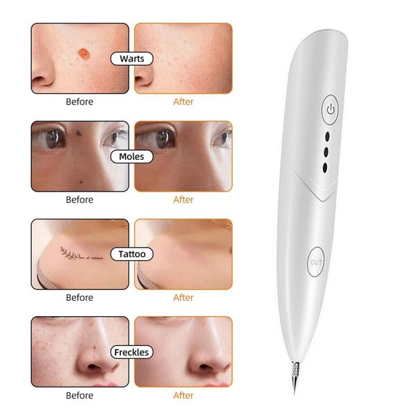 Laser Skin Tag Freckle Wart Dot Mole Remove Pen Dark Spot Tattoo Removal