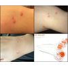 Dns Derma Skin Roller For Winkles & Scars (1.0mm)