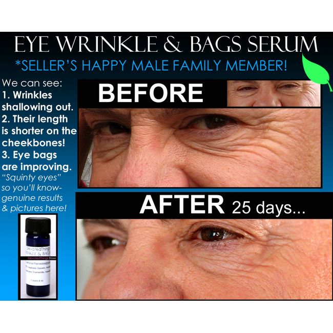 2 Before and After pics Under Eye Bags Best Wrinkle Remover Puffiness Bag Serum