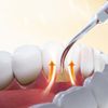 DTE Ultrasonic Scaler Tips,GD3,Sold by JMU
