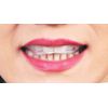 Topran Bruxic Mouthguard Fit