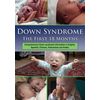 Down Syndrome: The First 18 Months