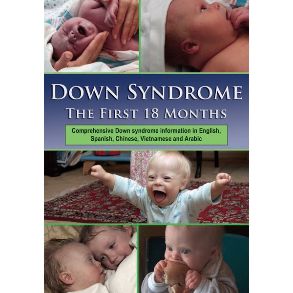 Down Syndrome: The First 18 Months