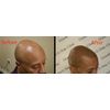 B - Scalp micropigmentation pigments by DermMicro (B)