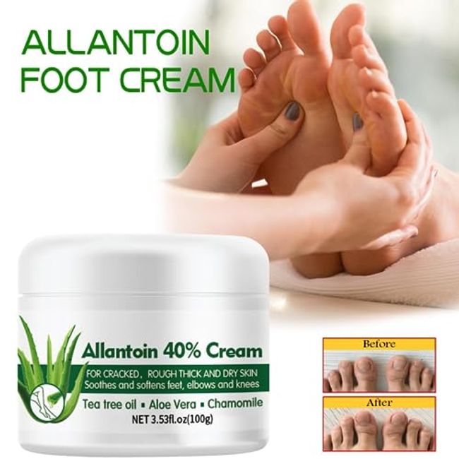 Urea 40% Foot Cream, Allantoin Foot Cream, Corn, Callus And Dead Skin  Remover Allantoin 40% Cream - Moisturizer & Rehydrater For Feet